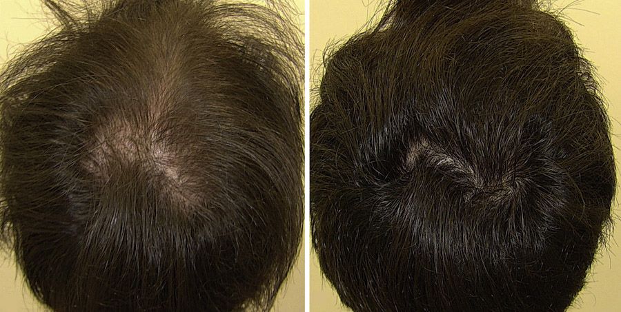 香港生髮bora hair